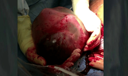 Doctor Delivers Baby Still in Amniotic Sac, Would Abortion be OK? | LifeNews.com